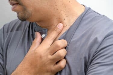 Removing Skin Tags: How To Completely Get Rid Of Them