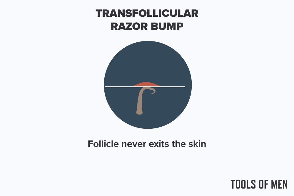 how long do razor bumps last - transfollicular razor bump