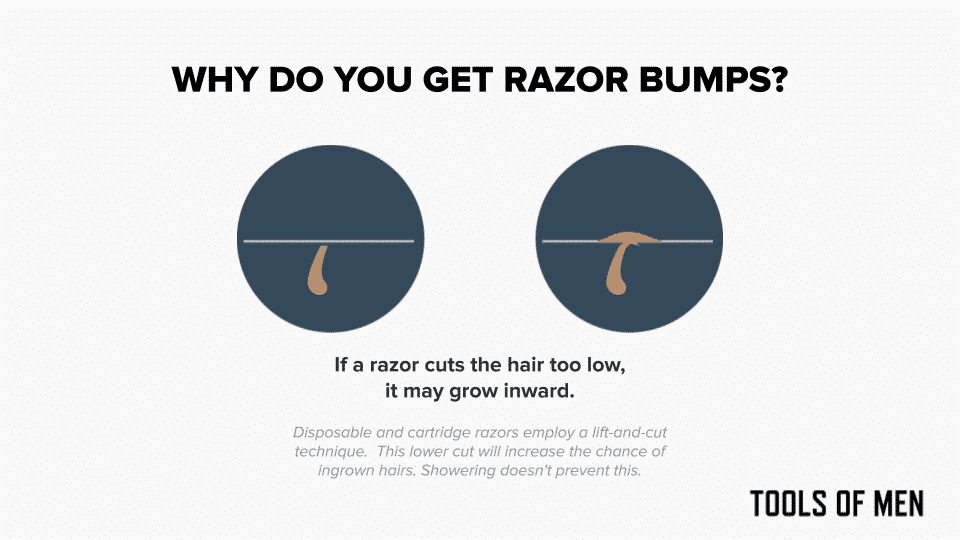 why do you get razor bumps