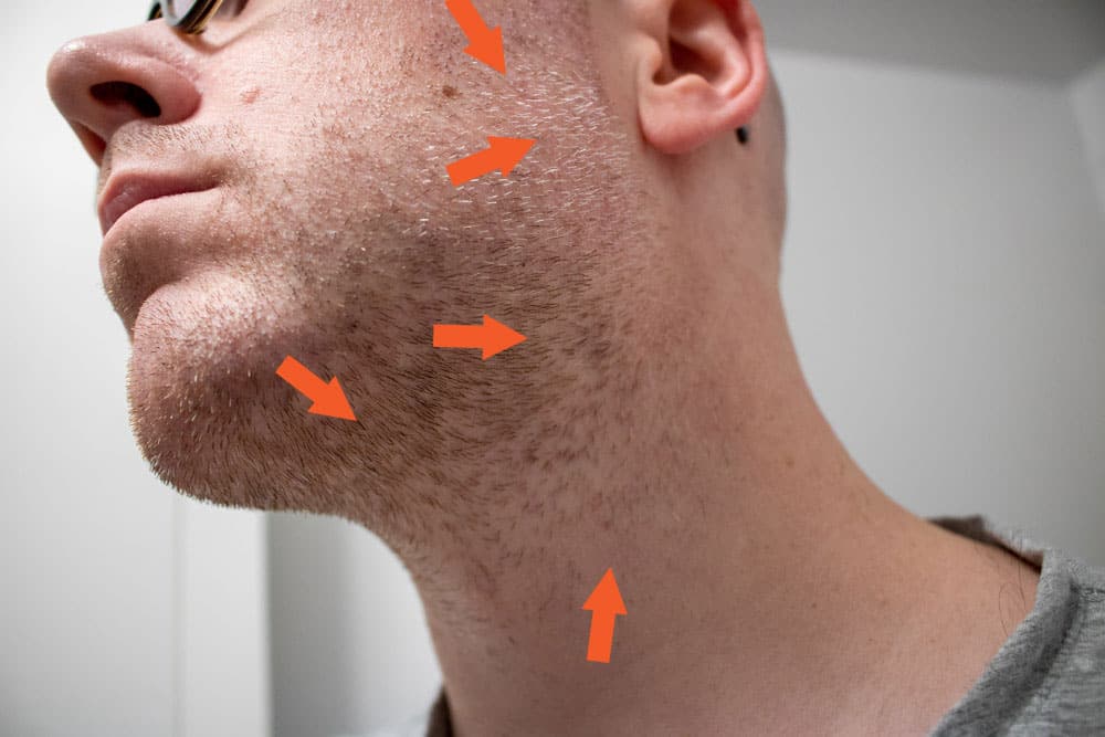 arrows demonstrating direction of hair growth on face