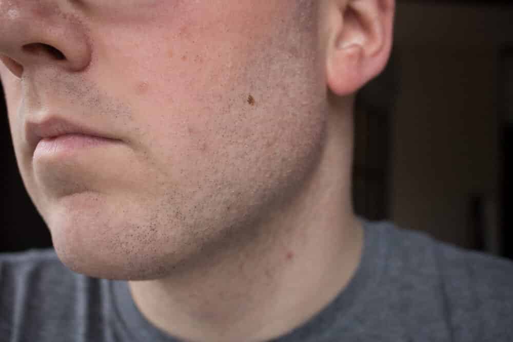 closeup of face after shaving with dollar shave club razor