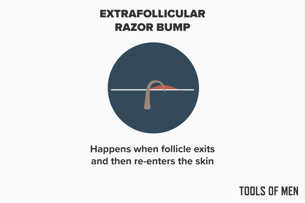 diagram explaining a Extrafollicular razor bump