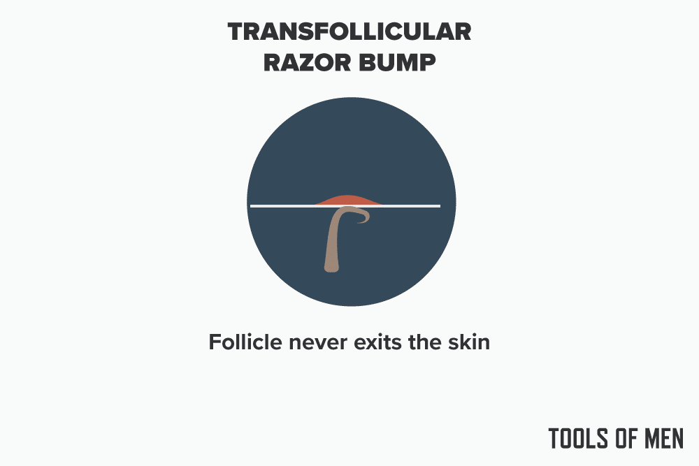 diagram explaining a Transfollicular razor bump