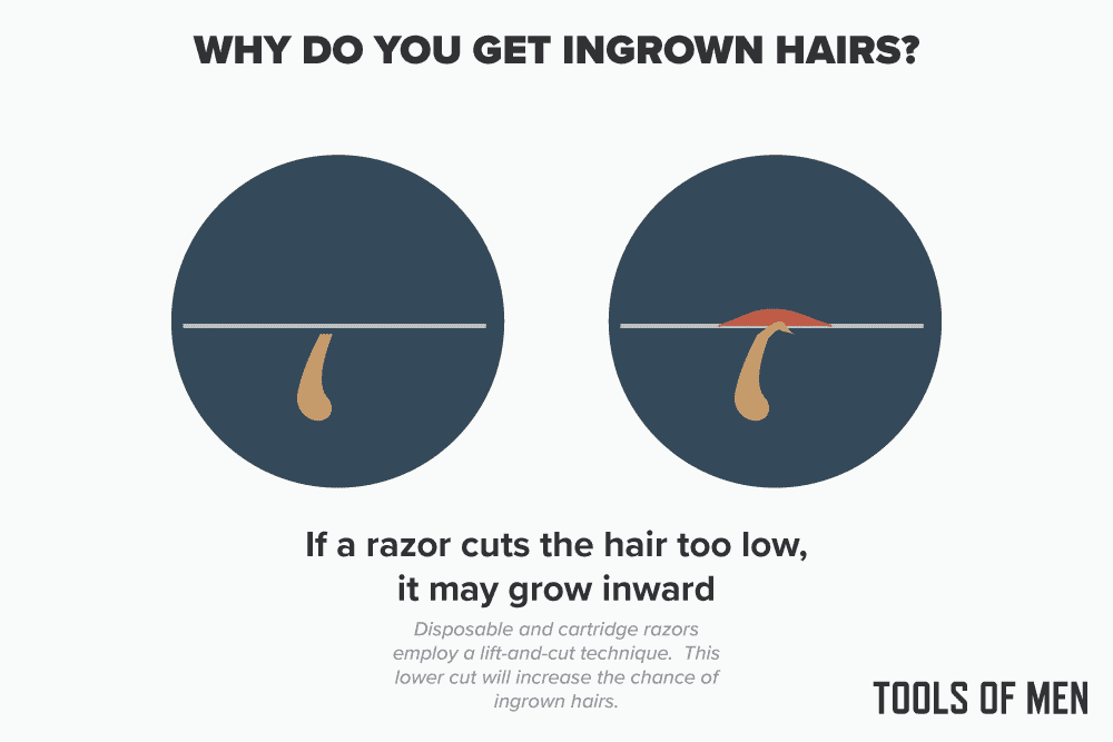diagram explaining how ingrown hairs form