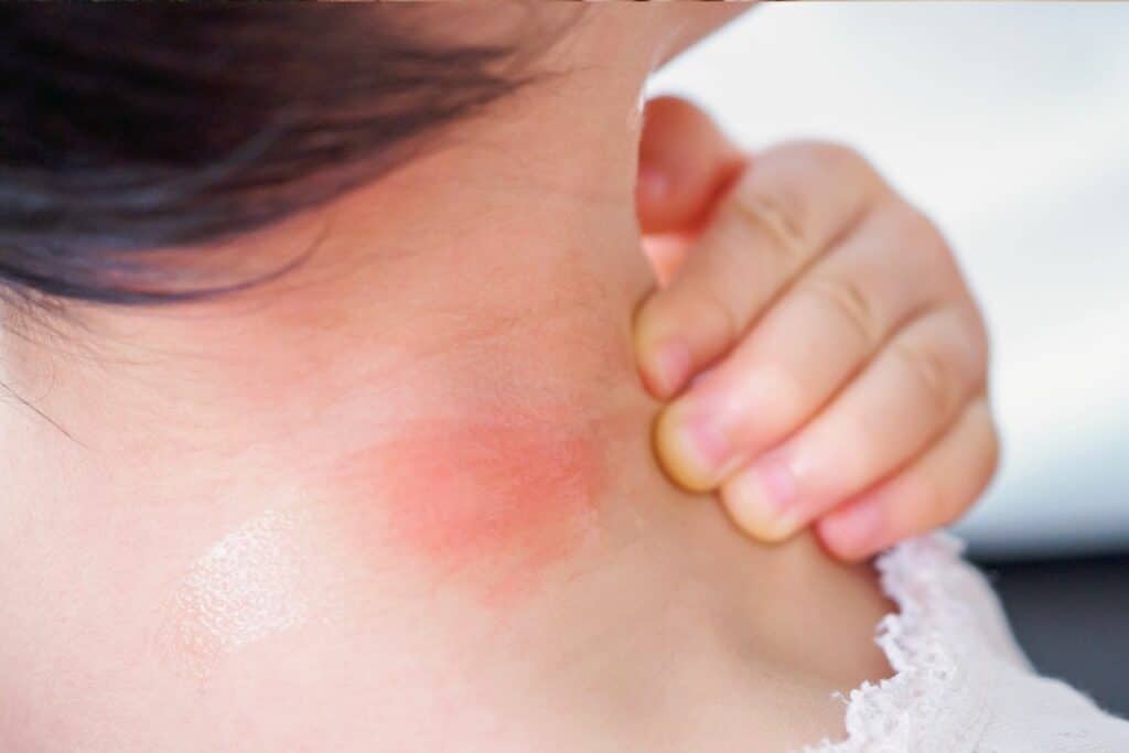 woman with redness on neck